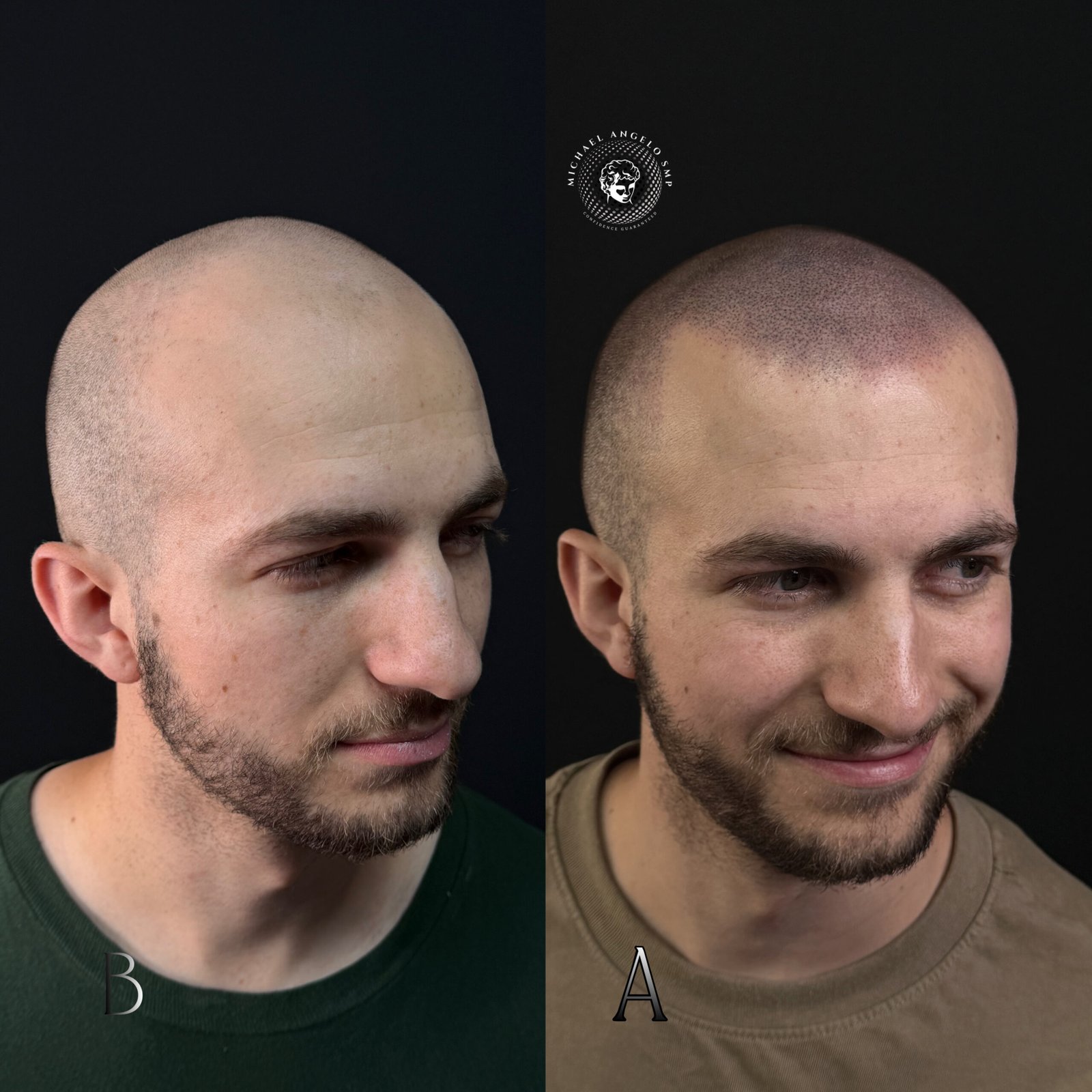 12 Custom SMP hairline result