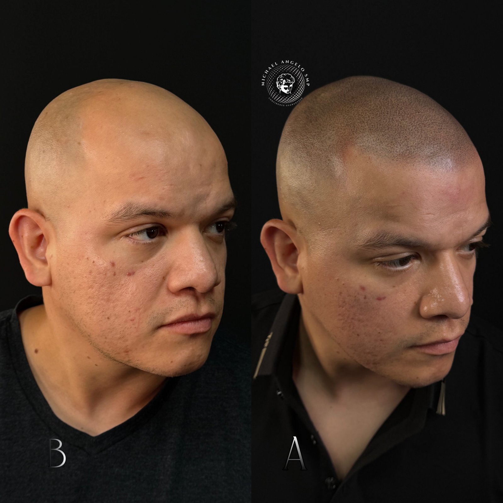 13 Natural shaved head scalp micropigmentation result