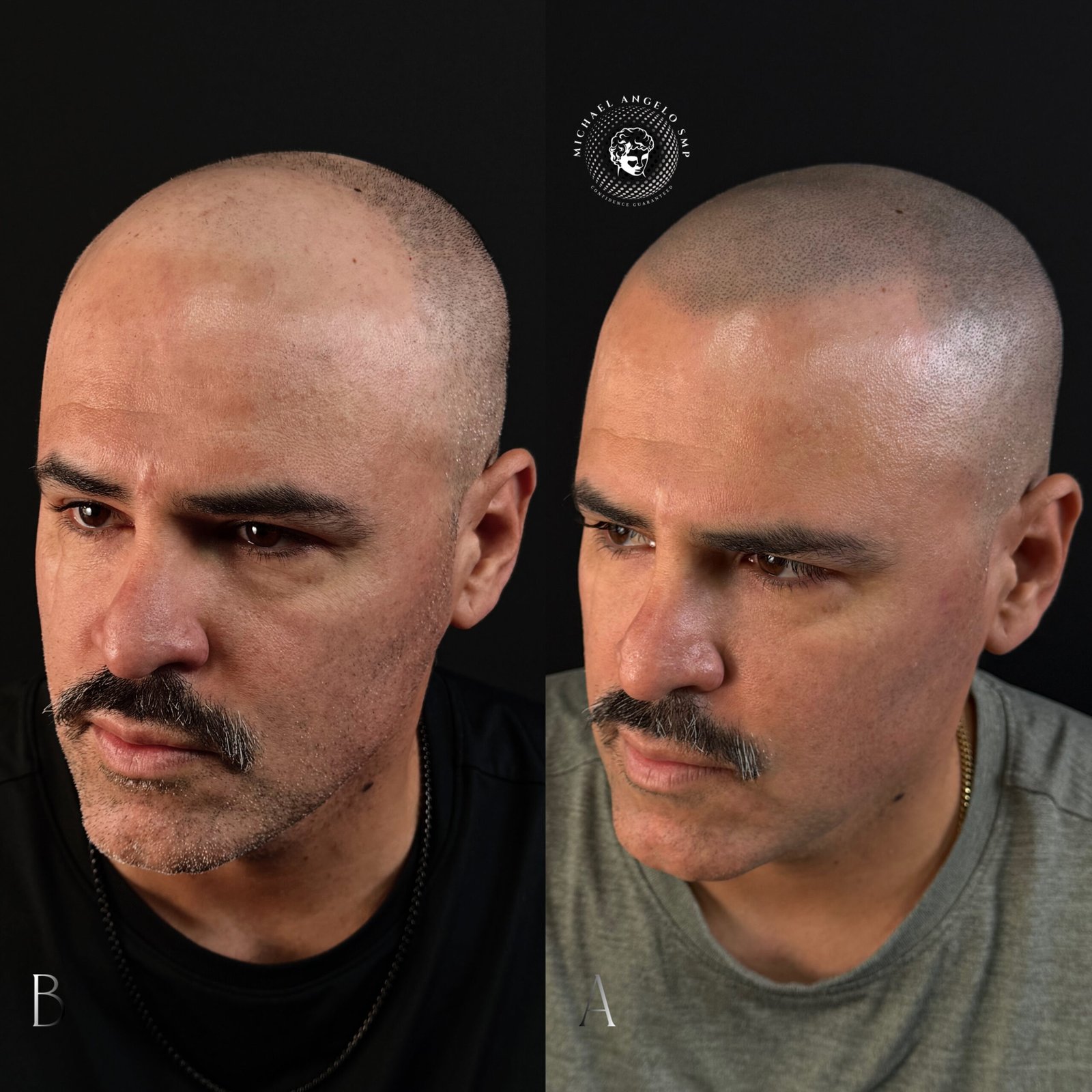 Scalp micropigmentation hairline transformation