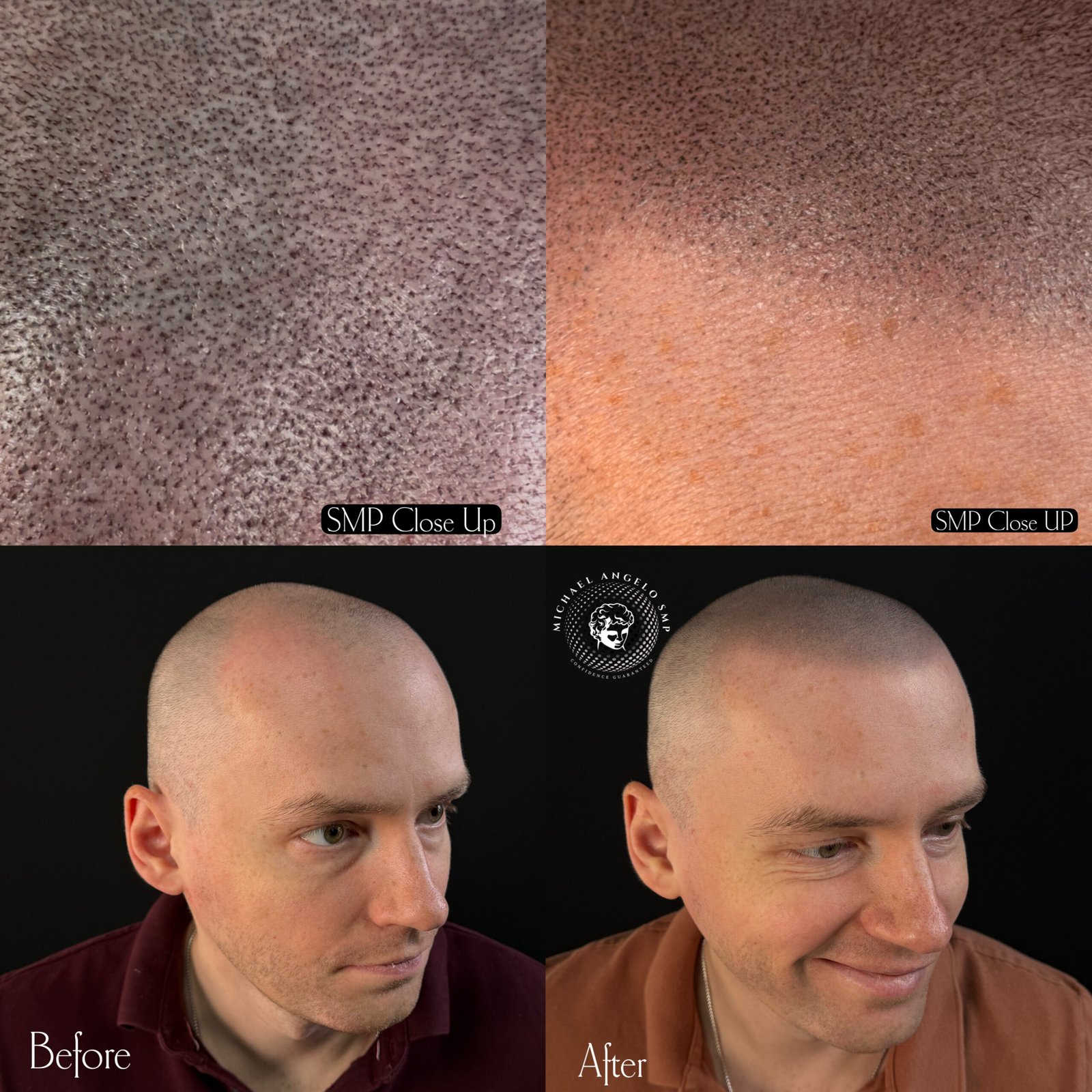 Close up density scalp micropigmentation impressions between existing hair