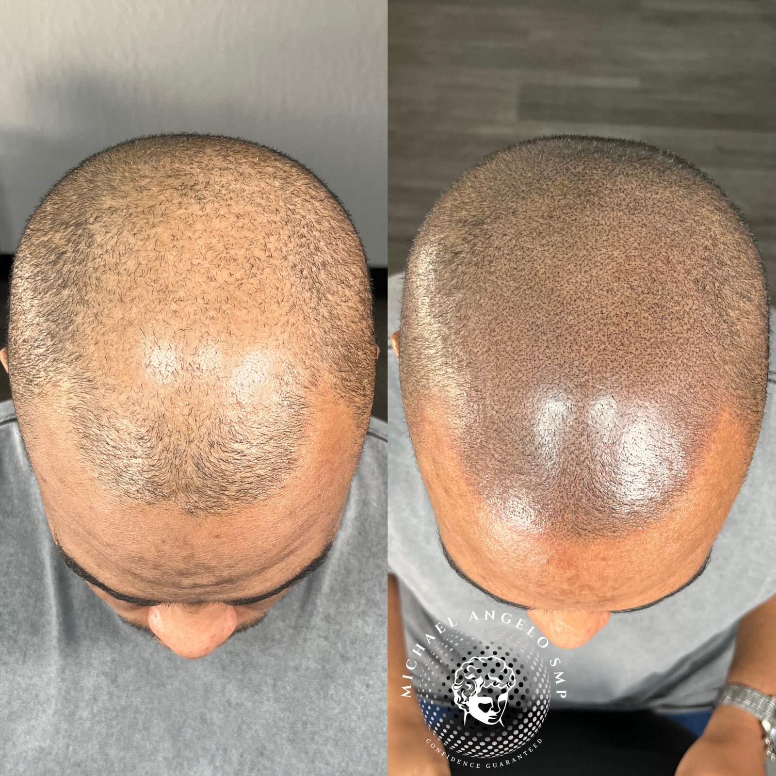 Hair micropigmentation density example