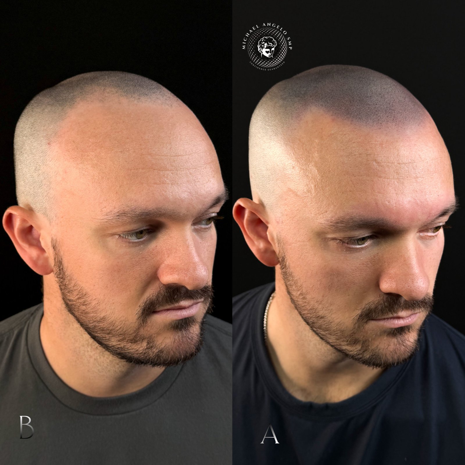 Before and after scalp micropigmentation treatment result