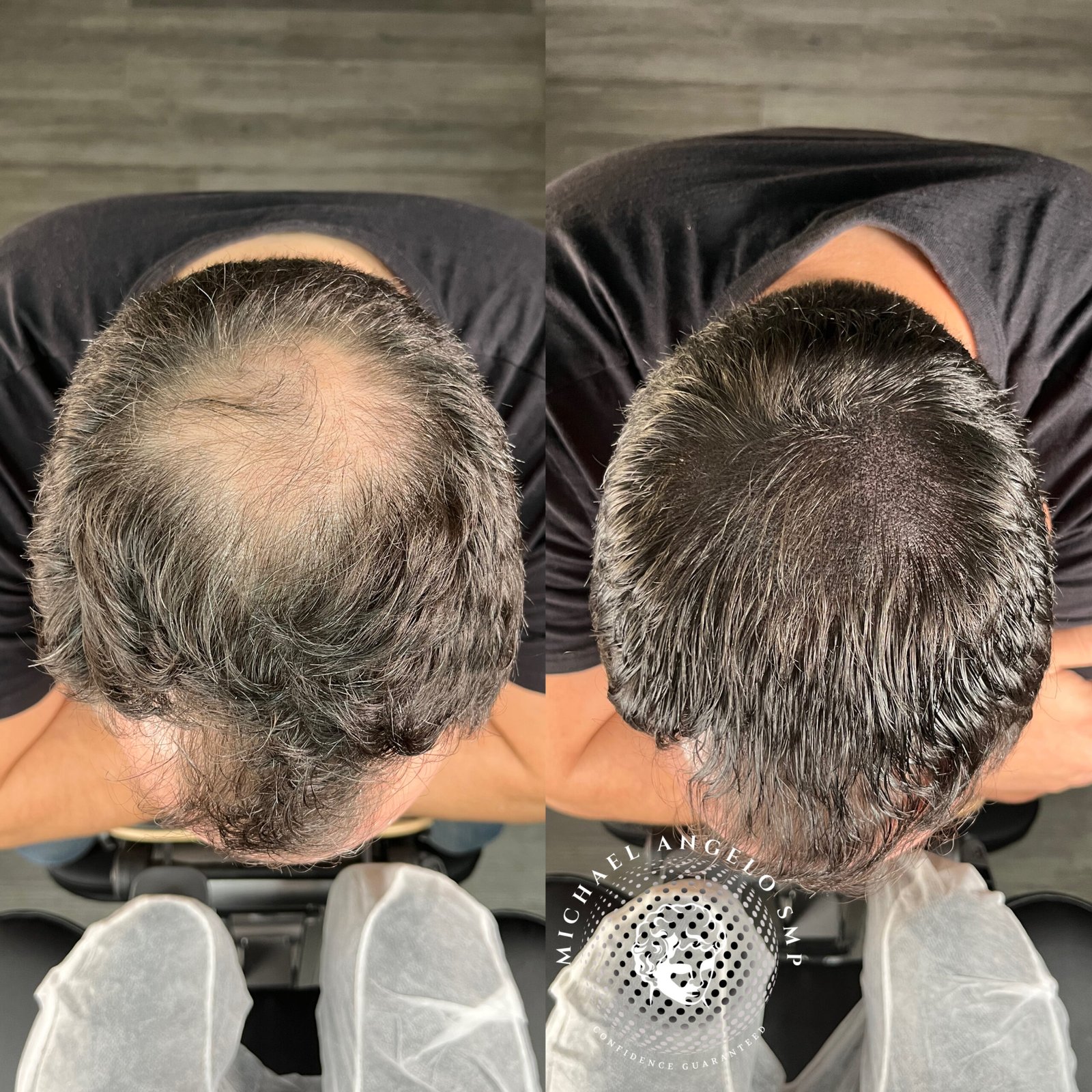 Scalp micropigmentation for existing hair