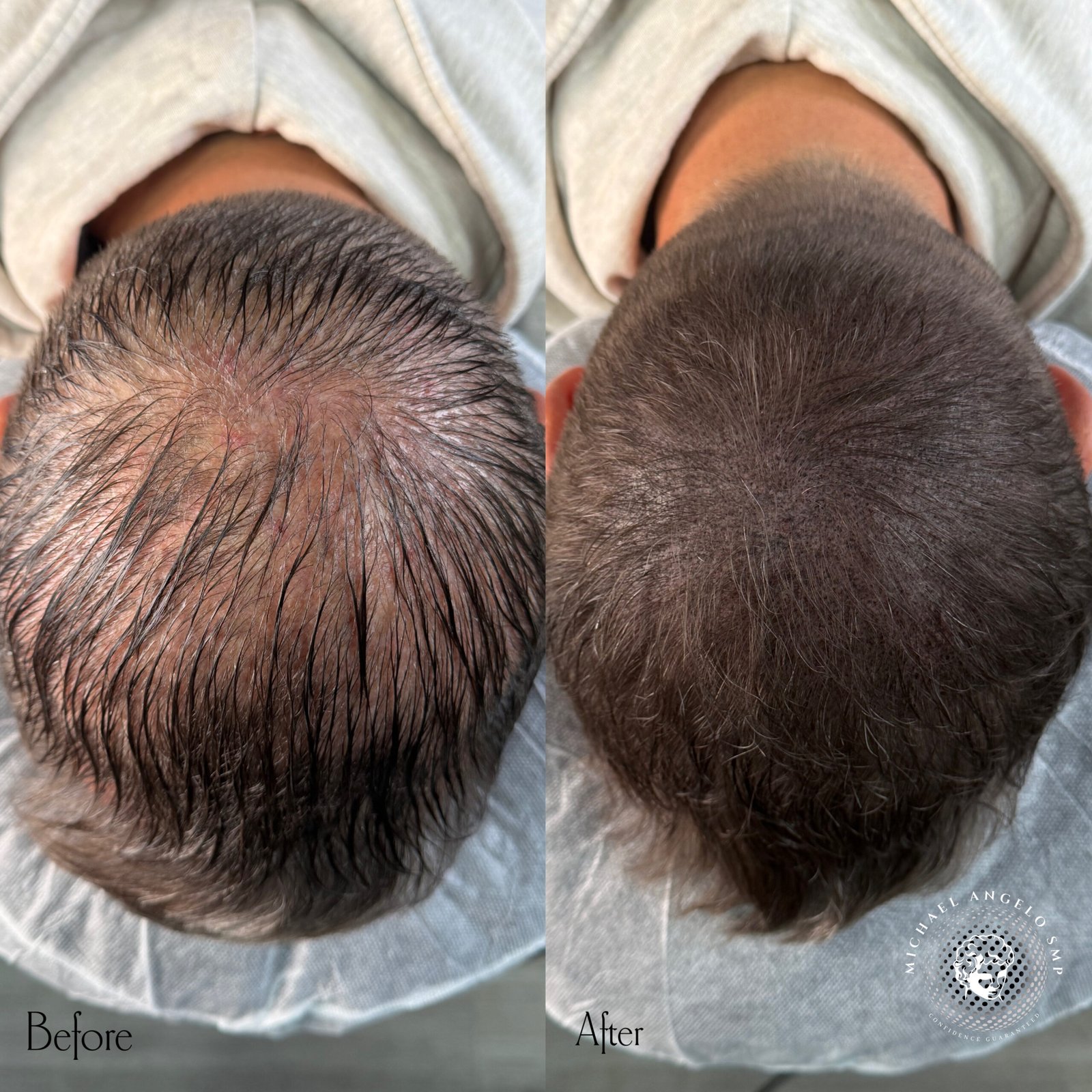 Crown hair micropigmentation before and after density SMP result