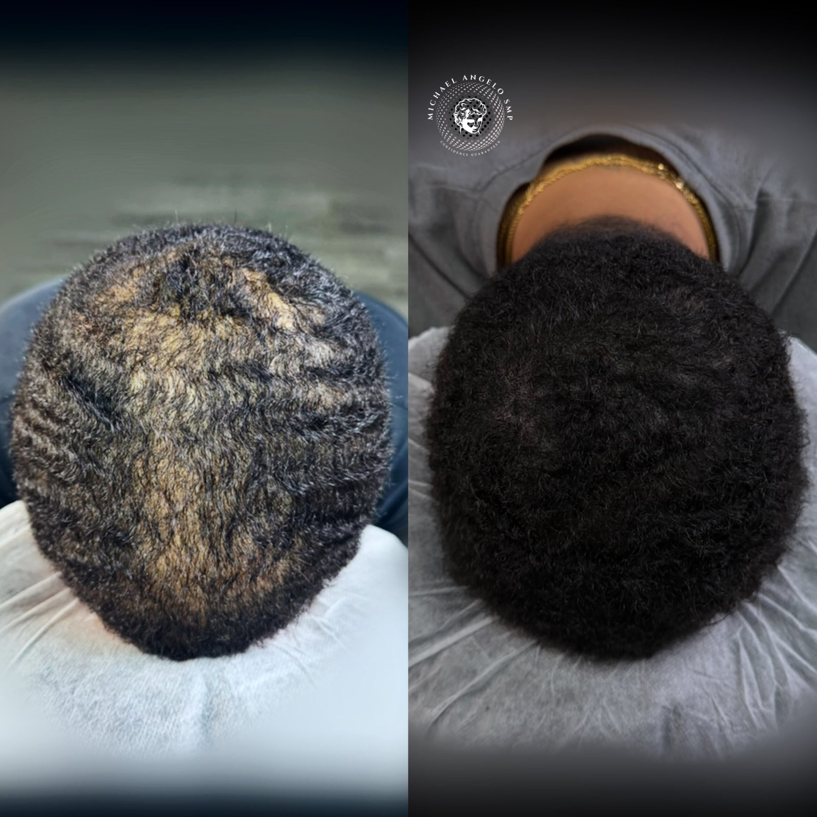Hair micropigmentation result Austin Texas