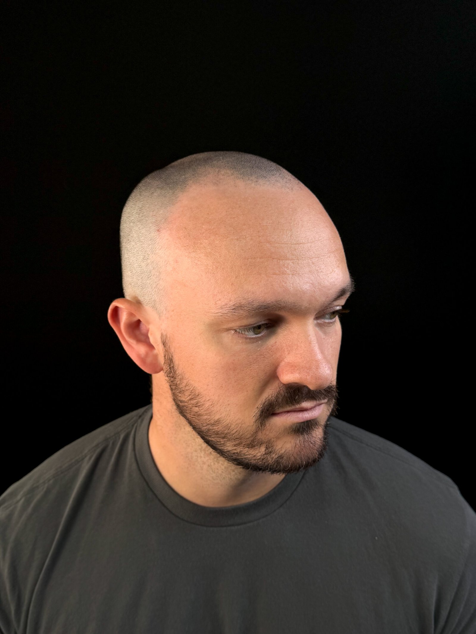 Before scalp micropigmentation treatment