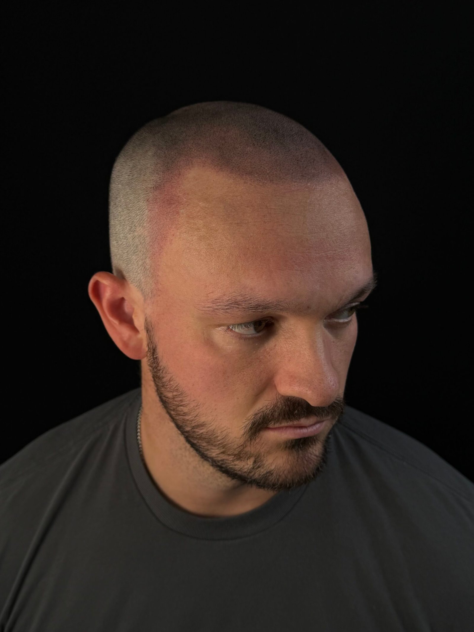 Fresh scalp micropigmentation after first SMP session