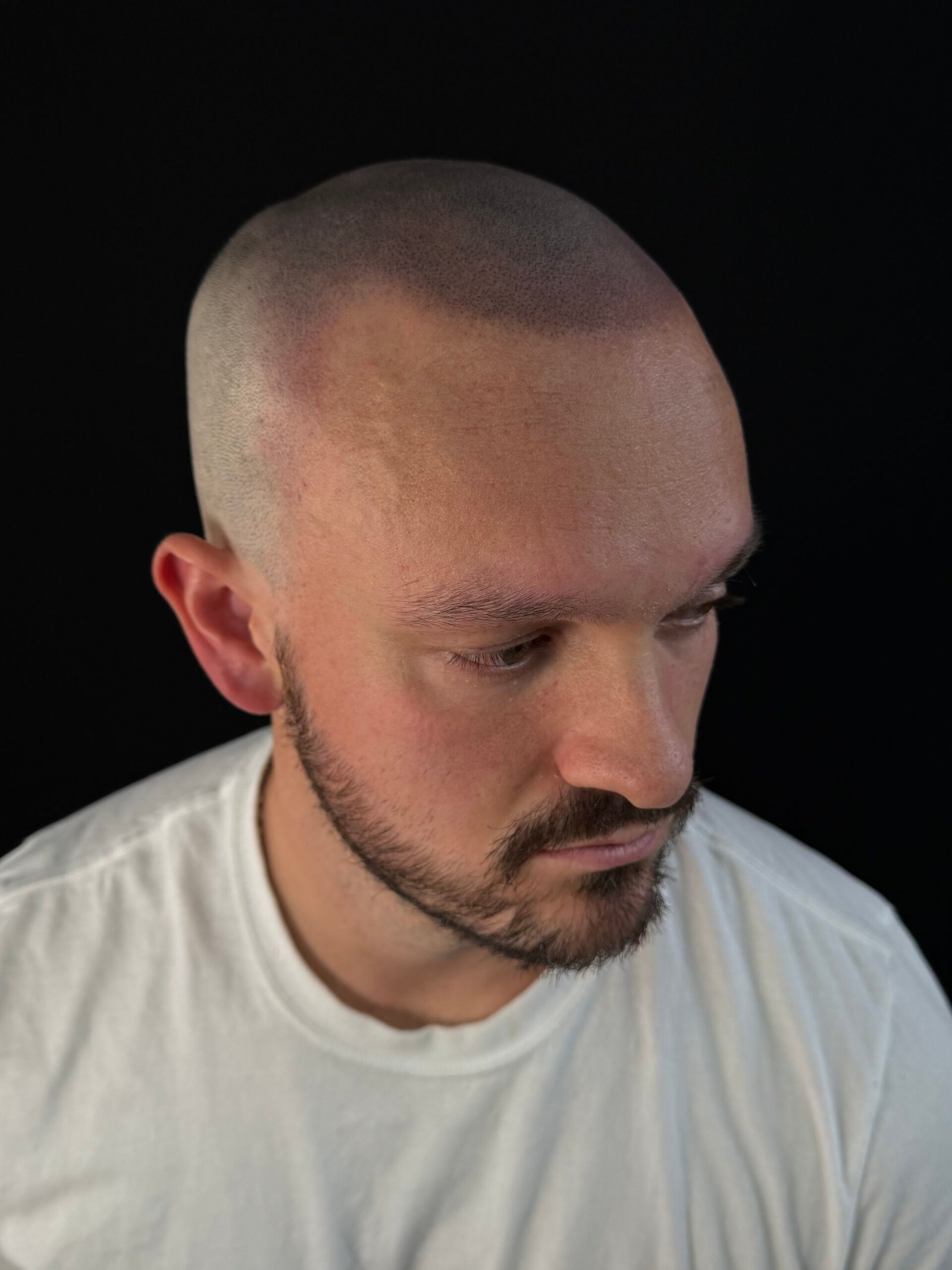 Scalp micropigmentation after second SMP treatment session