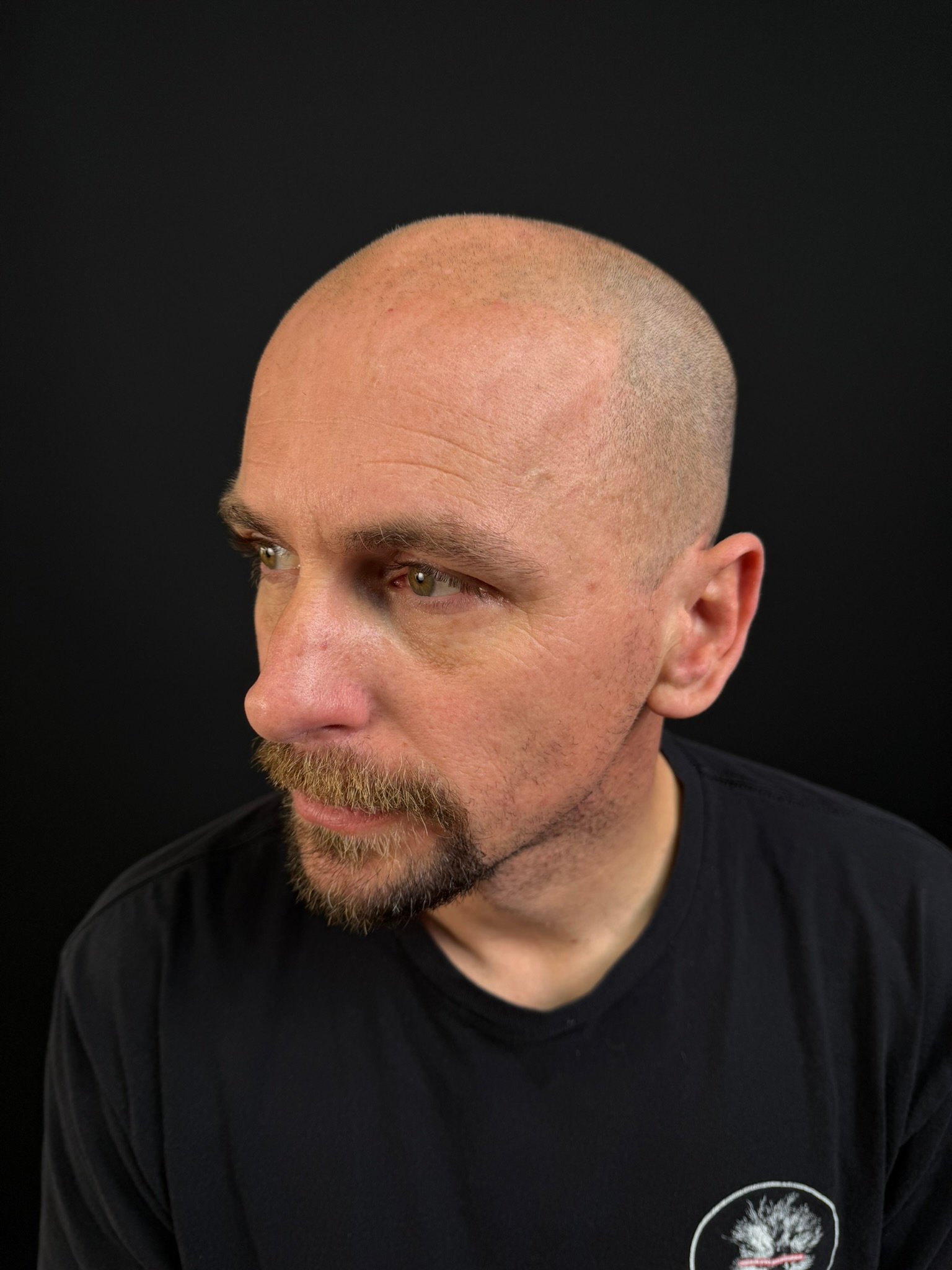 before: real client gradual shaved-head scalp micropigmentation at Michael Angelo SMP in Austin, Texas
