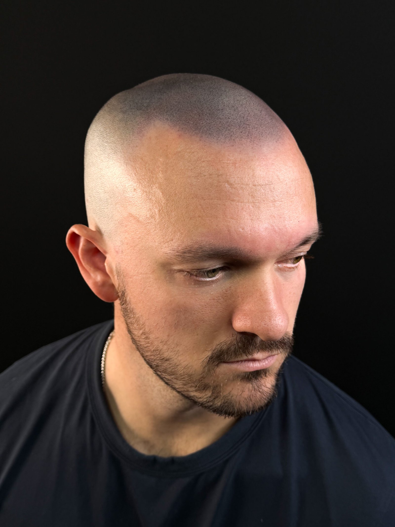 Fully healed scalp micropigmentation result after treatment