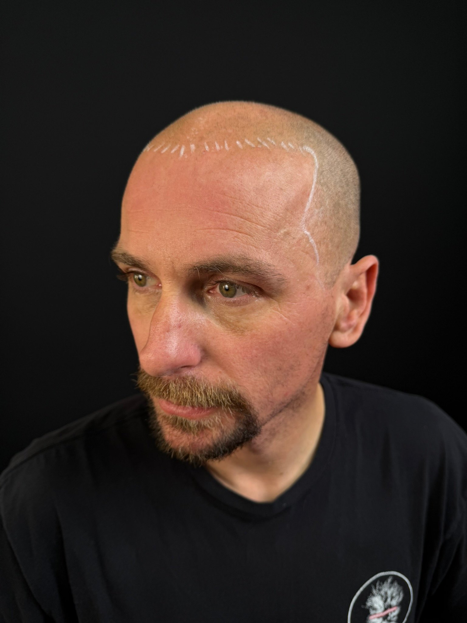 hairline mapping: real client gradual shaved-head scalp micropigmentation at Michael Angelo SMP in Austin, Texas