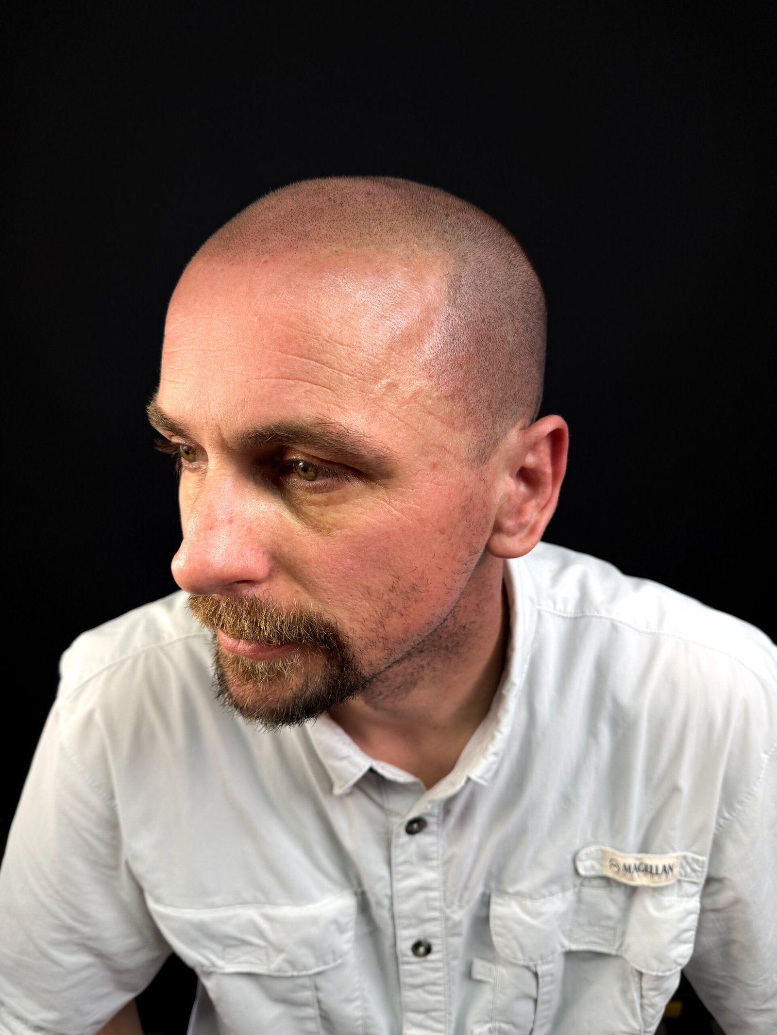 session 1 · 25%: real client gradual shaved-head scalp micropigmentation at Michael Angelo SMP in Austin, Texas