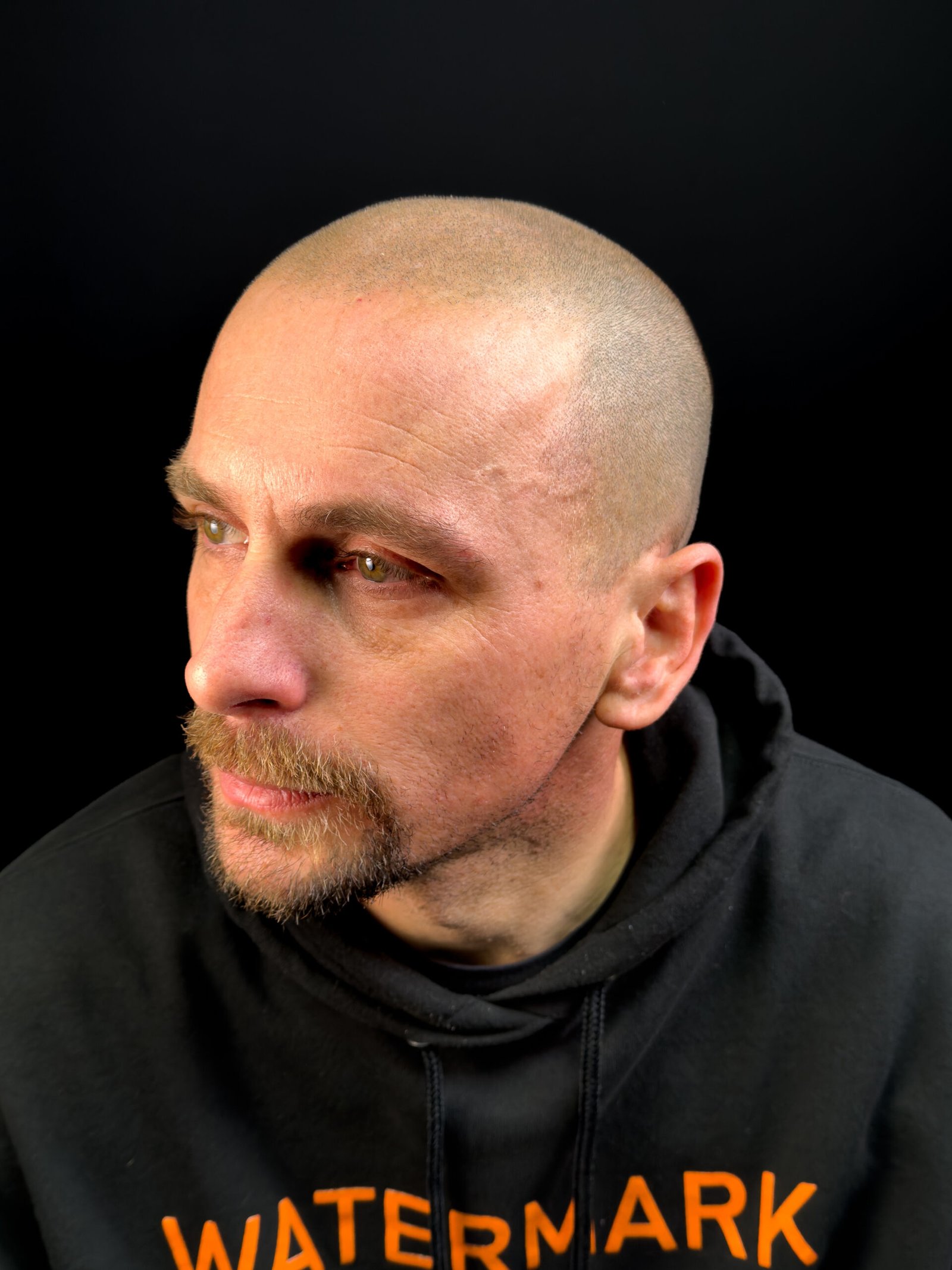 session 2 · 50%: real client gradual shaved-head scalp micropigmentation at Michael Angelo SMP in Austin, Texas