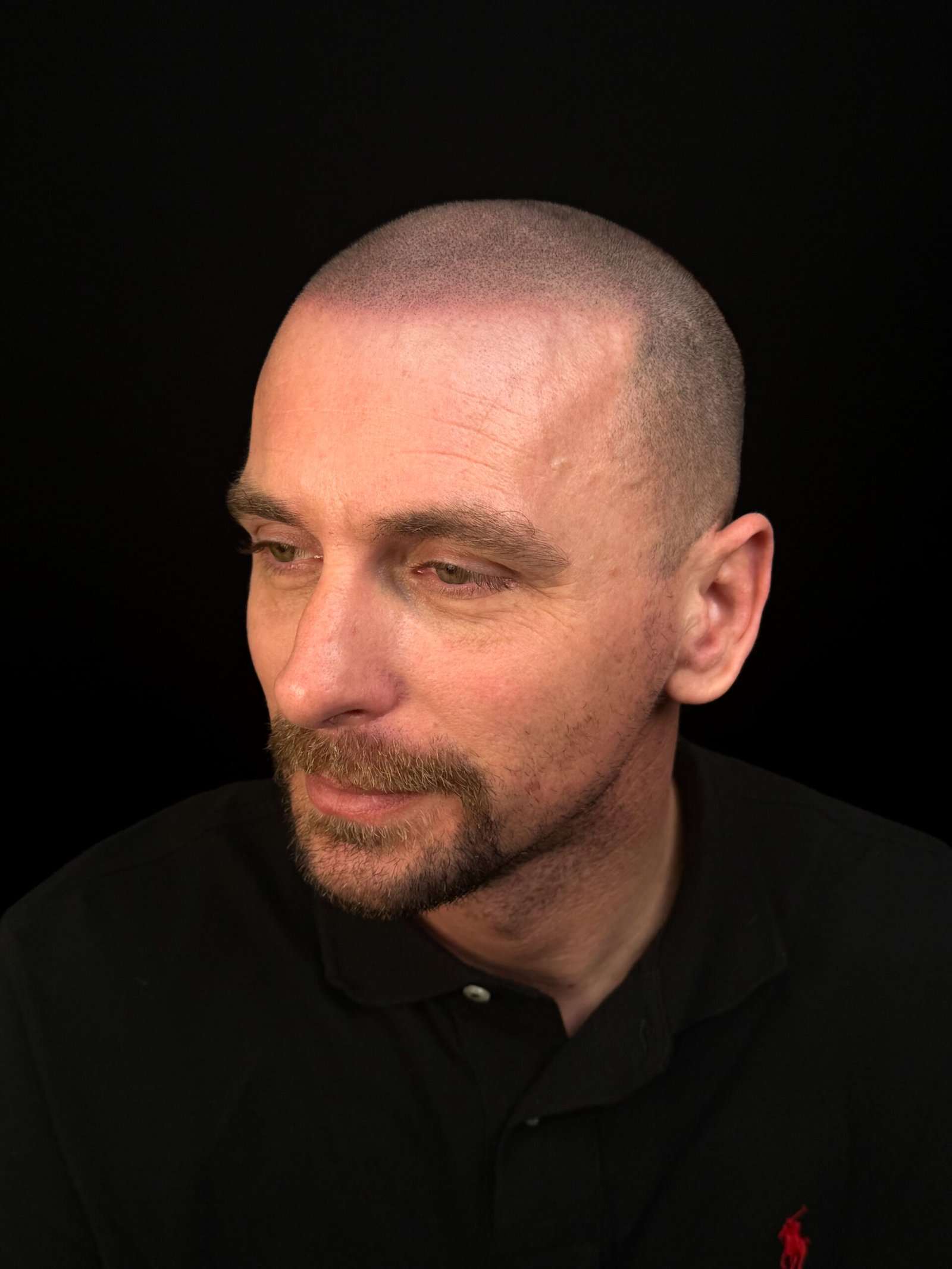 session 3 · 75%: real client gradual shaved-head scalp micropigmentation at Michael Angelo SMP in Austin, Texas