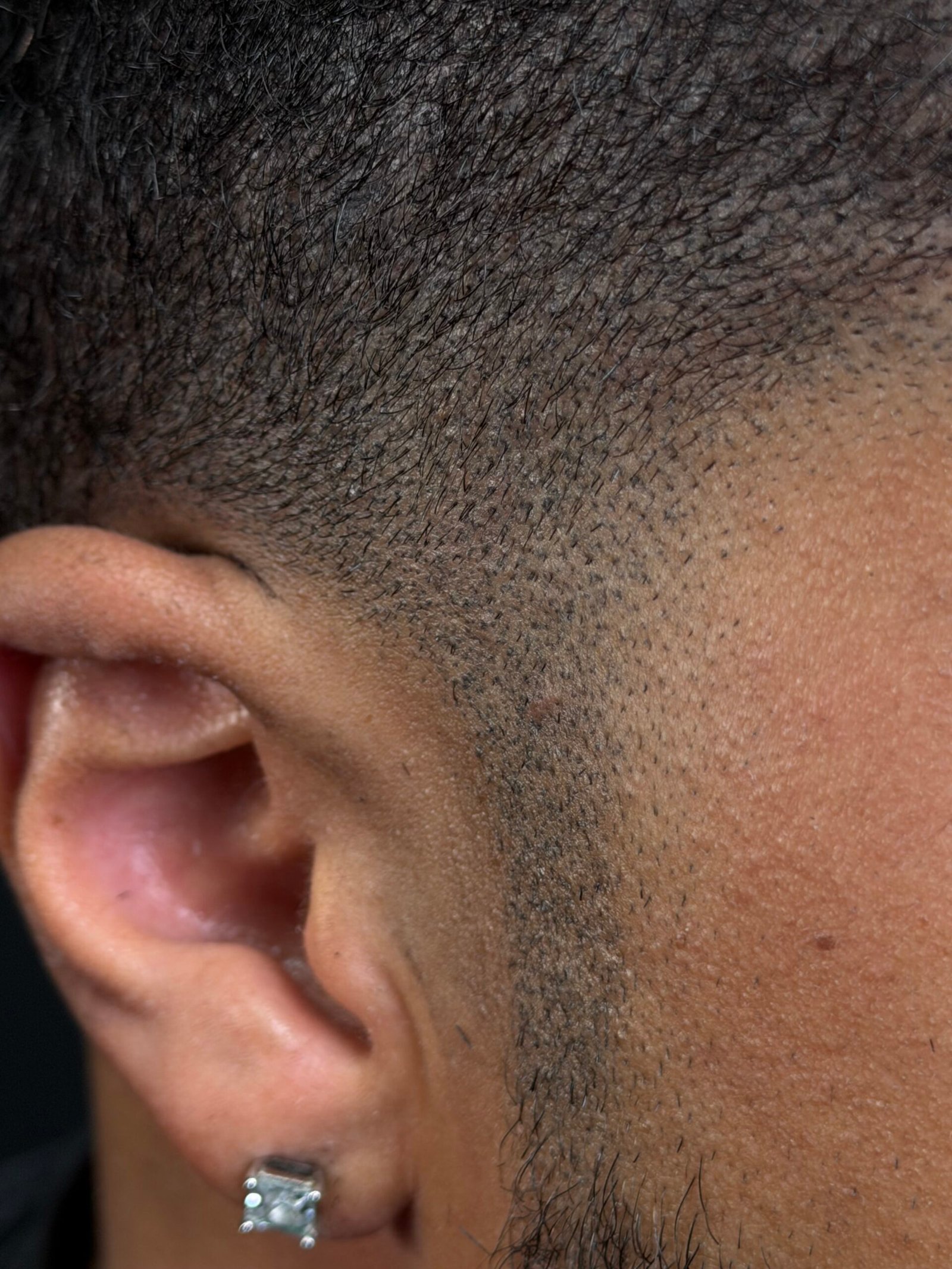 Hair density micropigmentation treatment